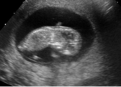 Embryo_at_11_weeks